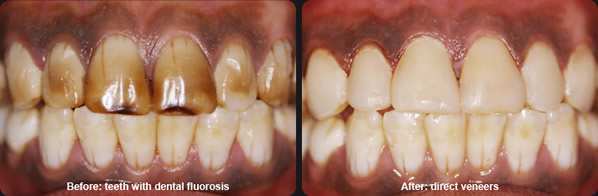 Dental fluorosis – Gurukrupa Dental